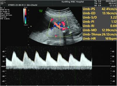 Case report of kabuki syndrome in a newborn caused by KMT2D gene mutation